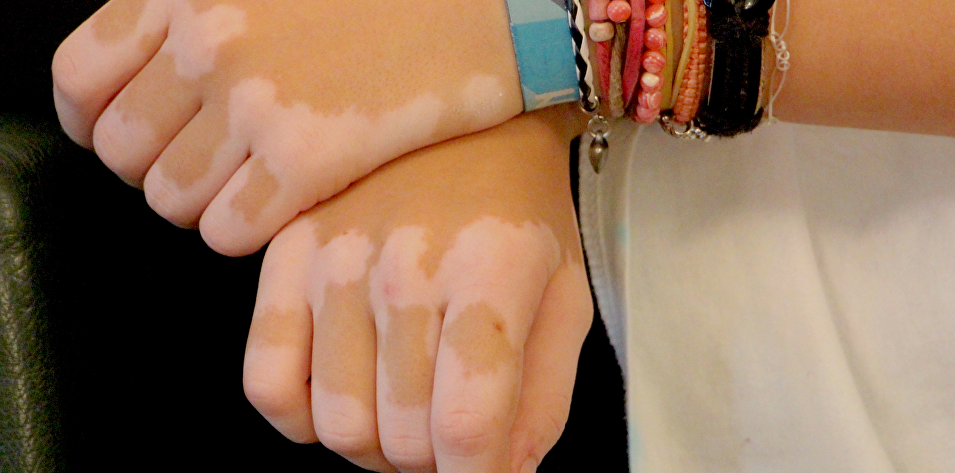 Informatiebijeenkomst Vitiligo