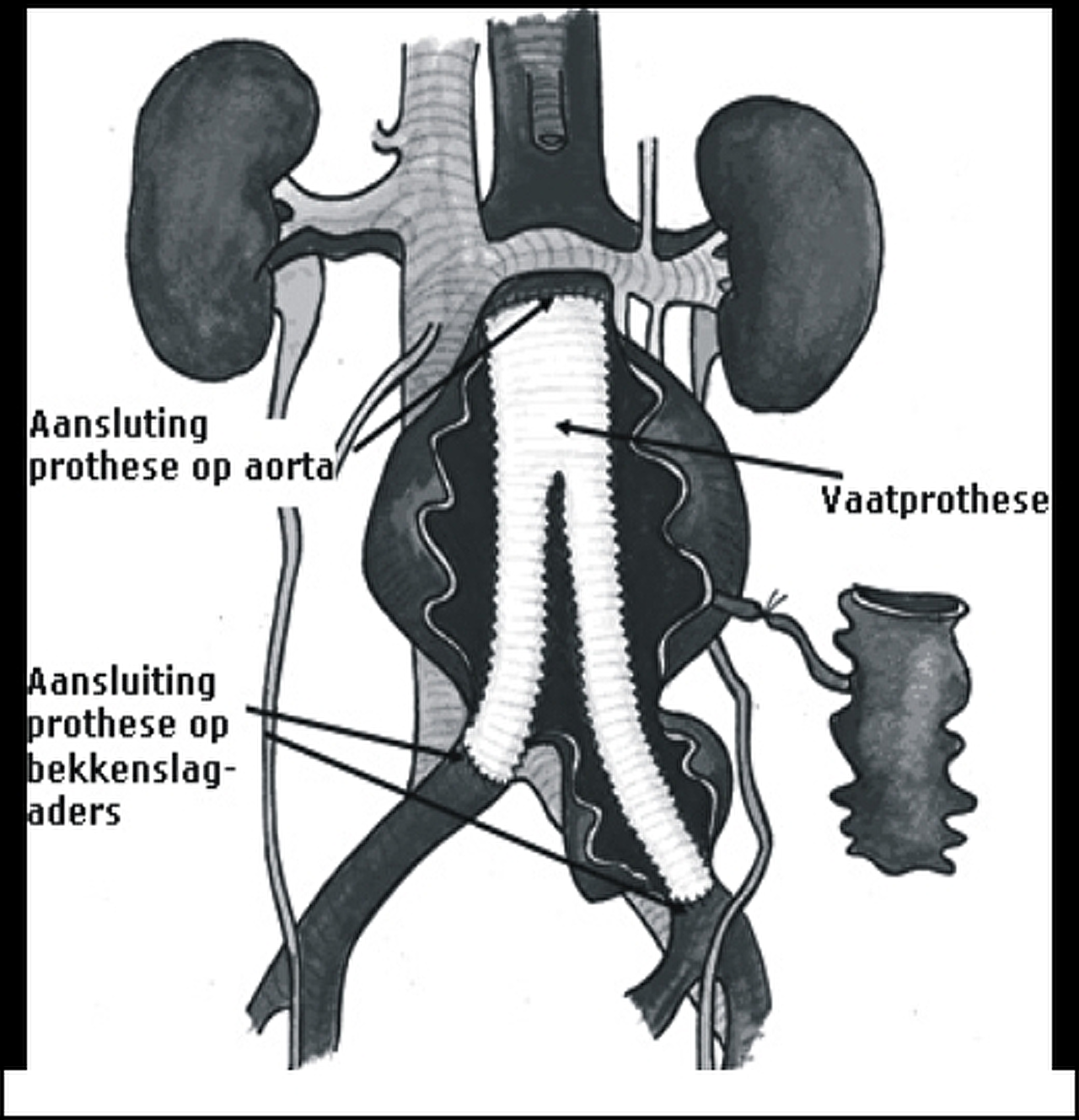 verwijding-van-de-buikslagader-aneurysma-aorta-abdominalis-aaa-bravis