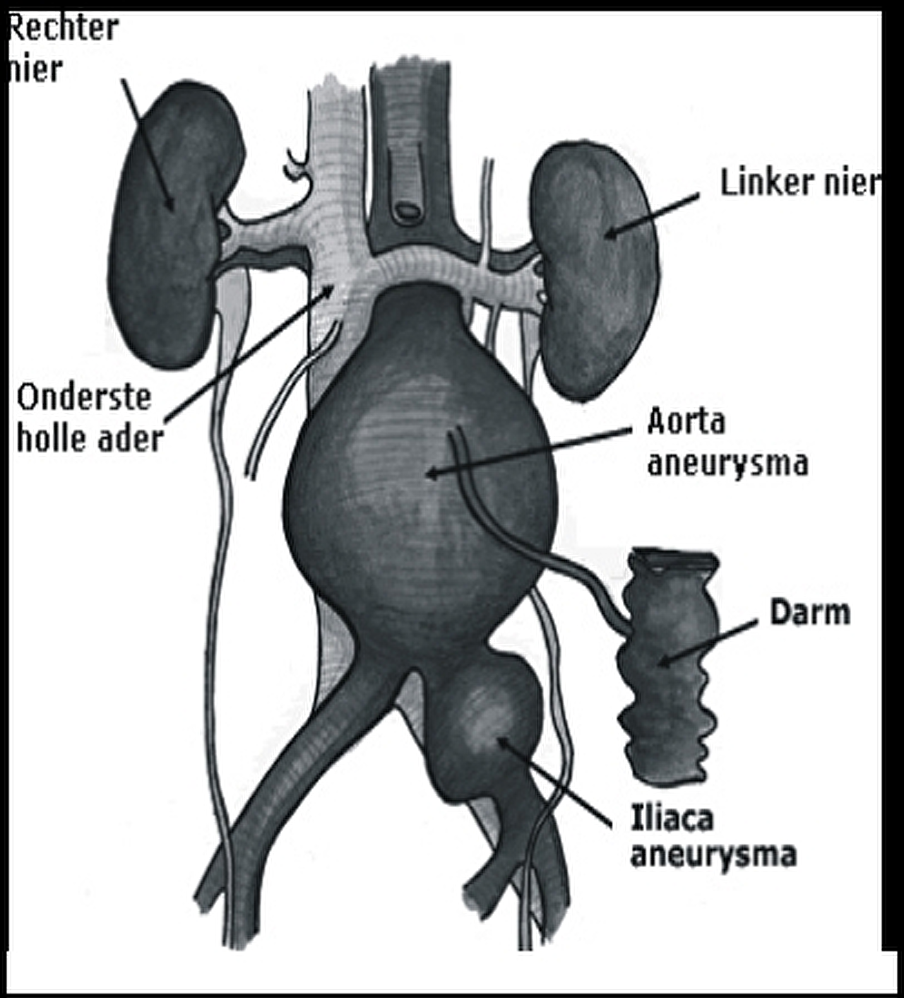 verwijding-van-de-buikslagader-aneurysma-aorta-abdominalis-aaa-bravis