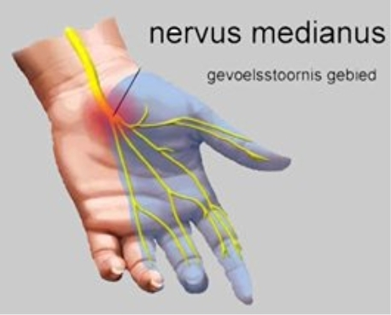 het_carpaletunnel_syndroom1-1