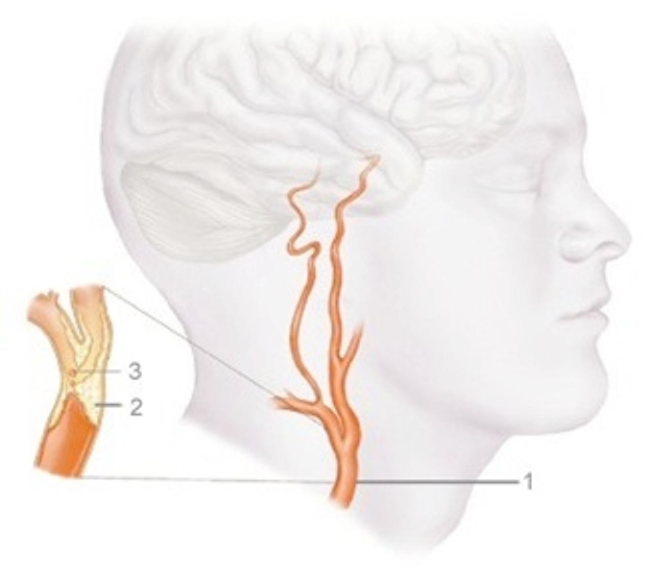 http://www.vaatchirurgie.info/www.vaatchirurgie.info/Carotisstenose_files/Carotid20artery.jpg http://www.vaatchirurgie.info/www.vaatchirurgie.info/Carotisstenose_files/Carotid20artery.jpg