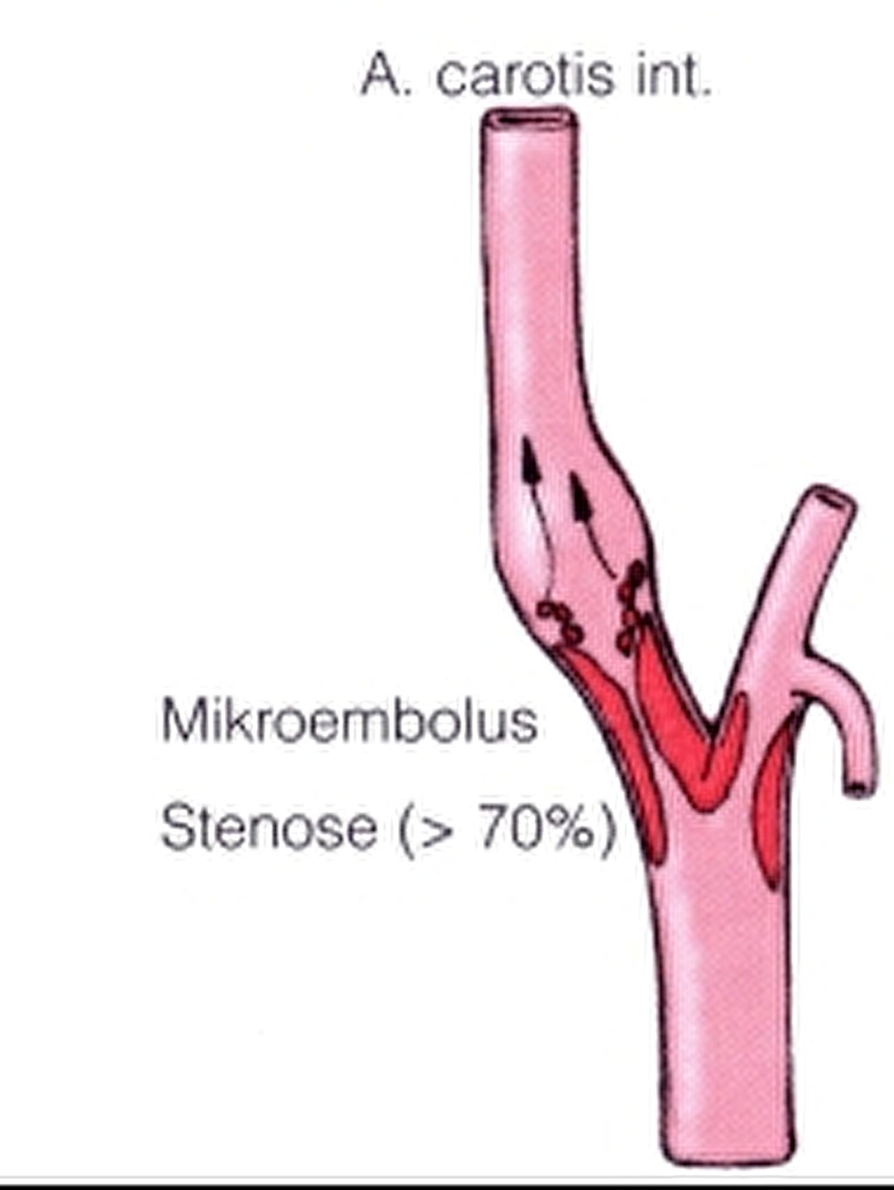 http://drugline.info/img/ail/karotisstenose-313_3.gif http://drugline.info/img/ail/karotisstenose-313_3.gif