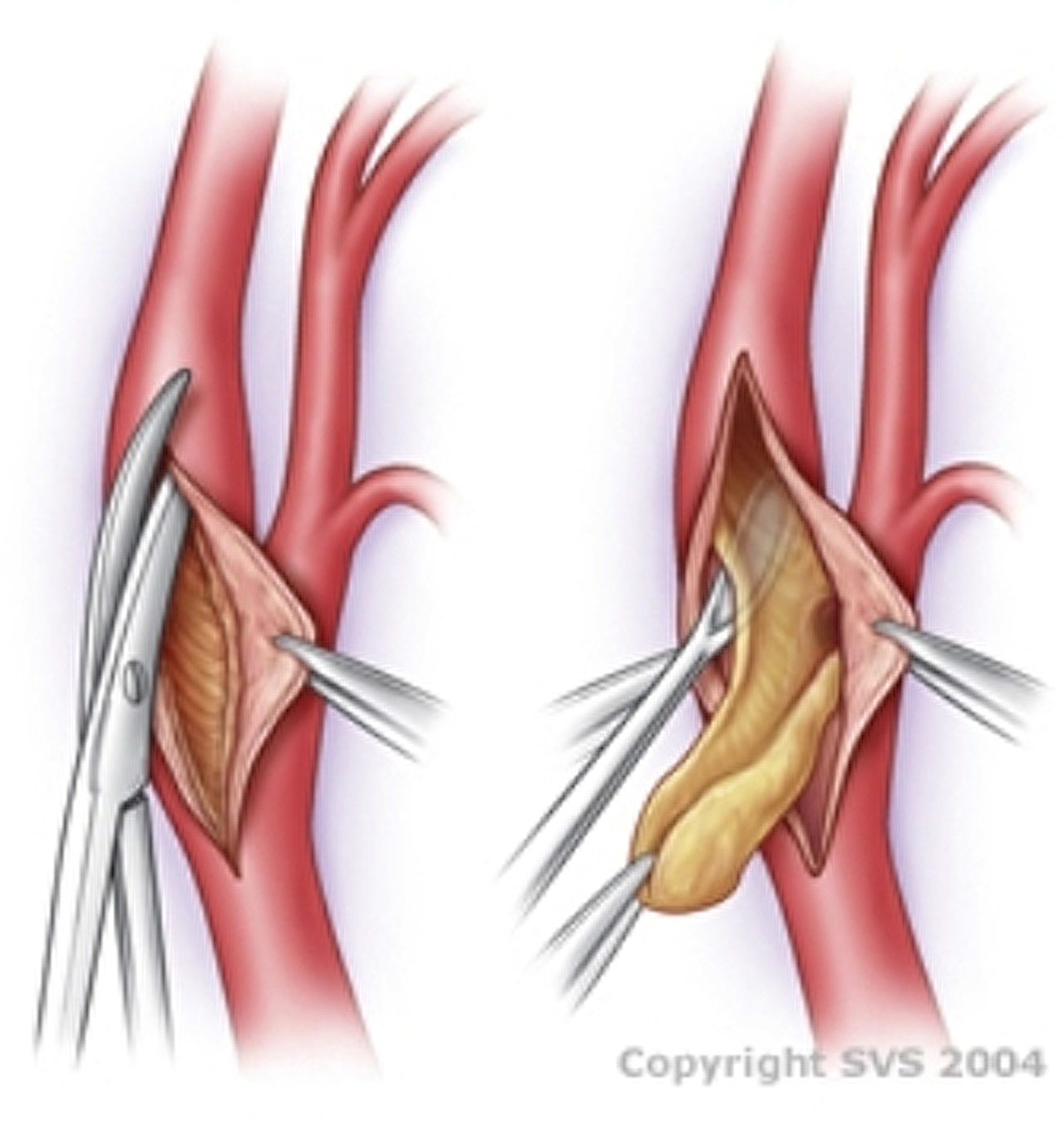 http://www.umcg.nl/SiteCollectionImages/UMCG/Afdelingen/Vaatcentrum/Carotid_01_250.jpg http://www.umcg.nl/SiteCollectionImages/UMCG/Afdelingen/Vaatcentrum/Carotid_01_250.jpg