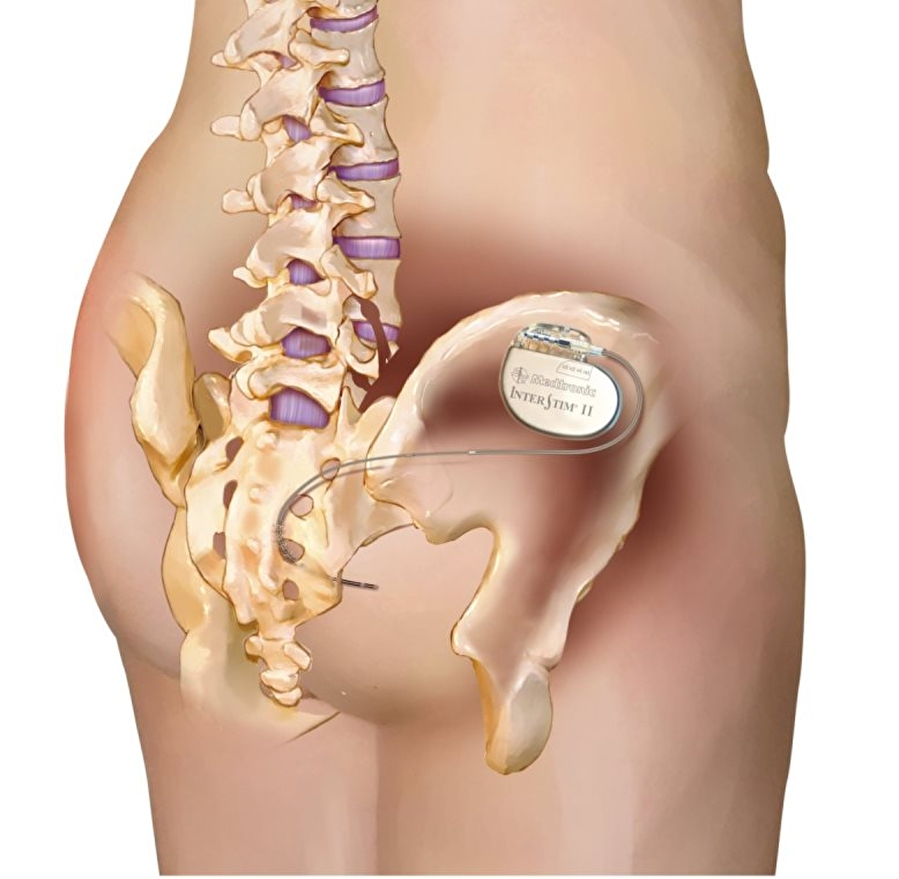interstim-permanent-system.jpg interstim-permanent-system.jpg
