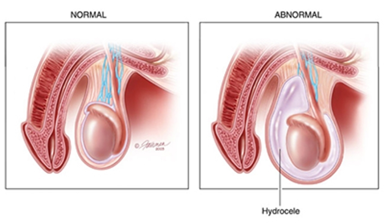 Hydrocele