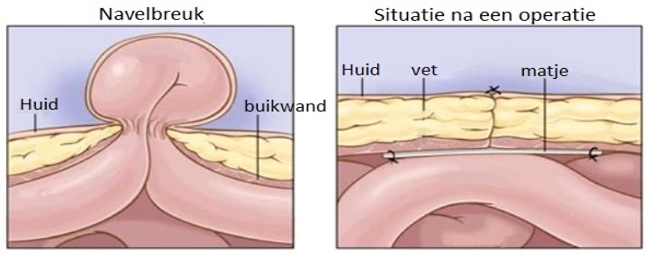 navelbreuk