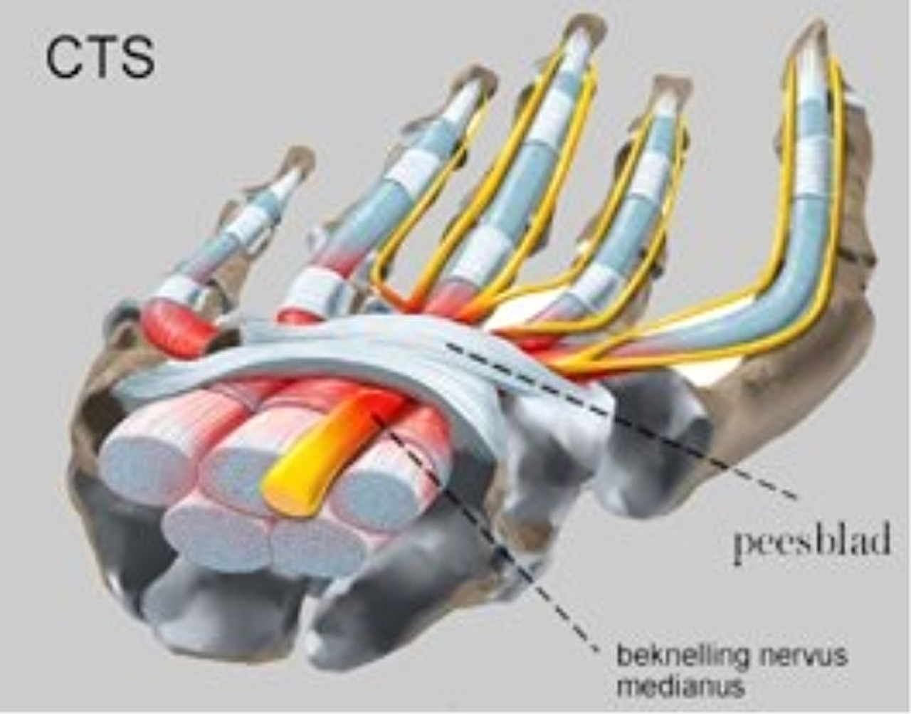 het_carpaletunnel_syndroom1-2 het_carpaletunnel_syndroom1-2