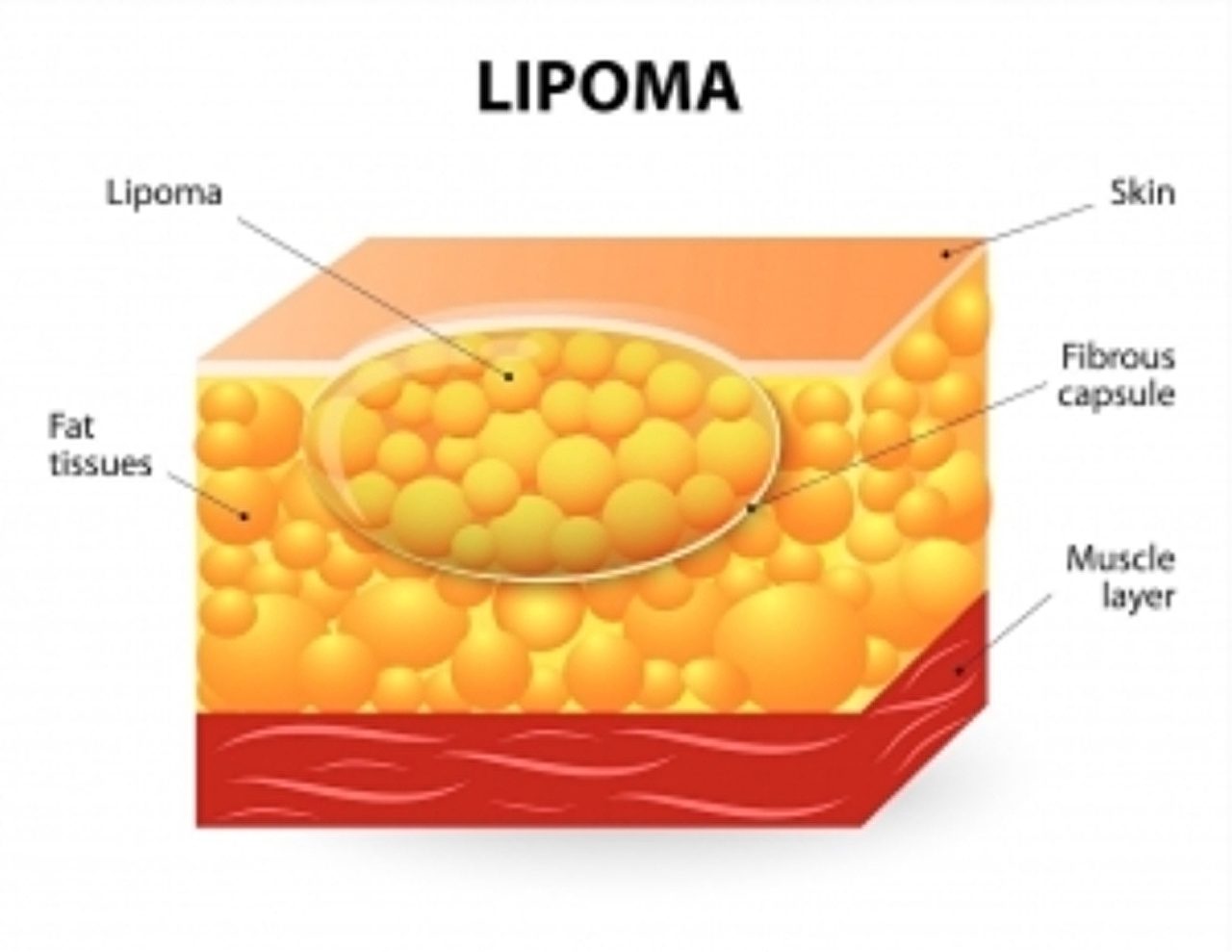lipoma lipoma