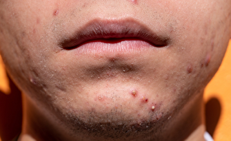 Acne