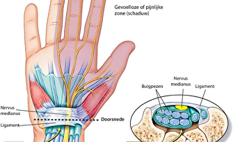 Tintelende hand/ carpaal tunnel syndroom (CTS)