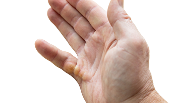 M. Dupuytren/ koetsiershand