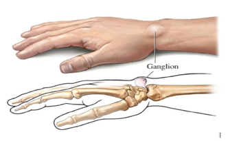 Cyste in de pols (ganglion)